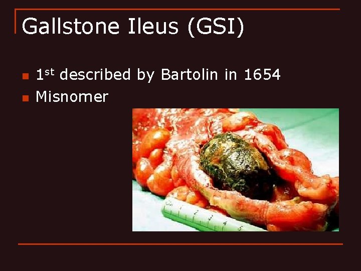 Gallstone Ileus (GSI) n n 1 st described by Bartolin in 1654 Misnomer 