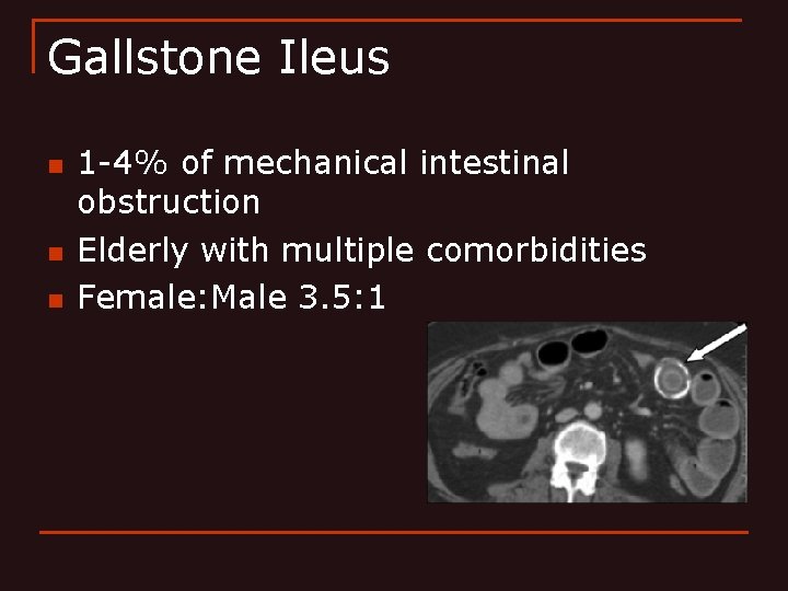 Gallstone Ileus n n n 1 -4% of mechanical intestinal obstruction Elderly with multiple