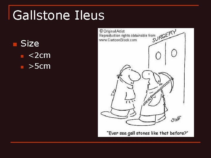 Gallstone Ileus n Size n n <2 cm >5 cm 