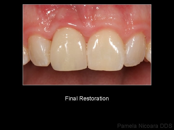 Final Restoration Pamela Nicoara DDS 