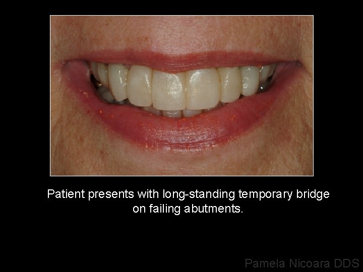 Patient presents with long-standing temporary bridge on failing abutments. Pamela Nicoara DDS 