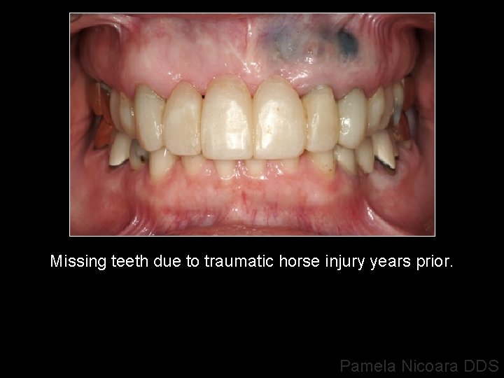 Missing teeth due to traumatic horse injury years prior. Pamela Nicoara DDS 