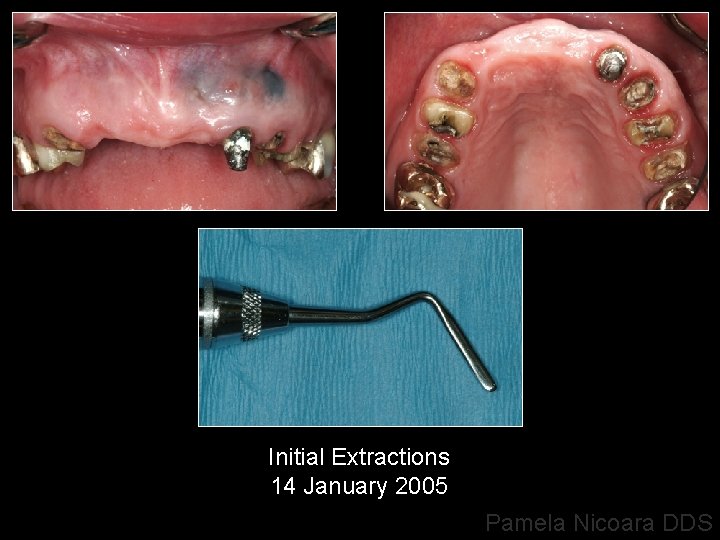 Initial Extractions 14 January 2005 Pamela Nicoara DDS 