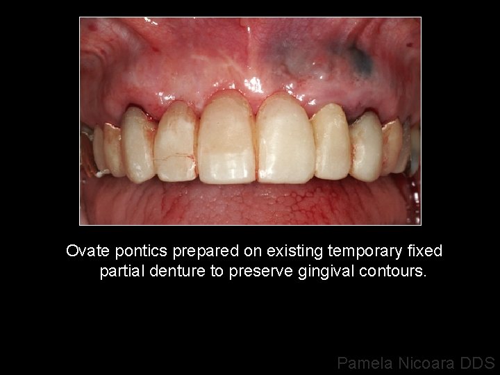 Ovate pontics prepared on existing temporary fixed partial denture to preserve gingival contours. Pamela