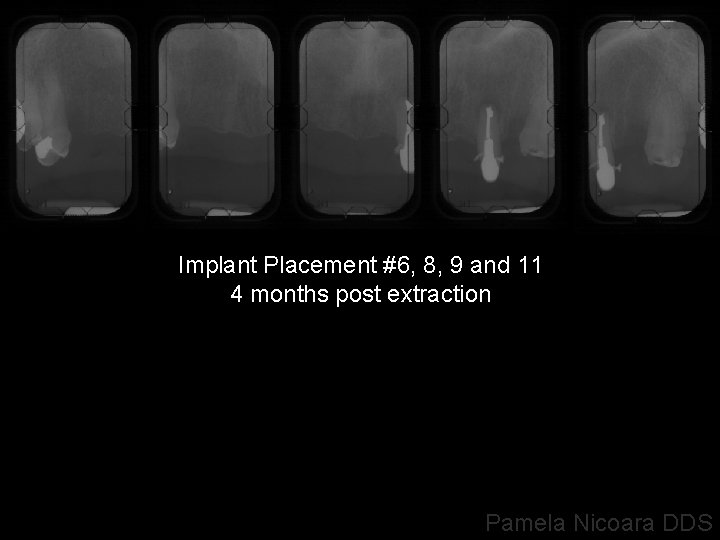 Implant Placement #6, 8, 9 and 11 4 months post extraction Pamela Nicoara DDS