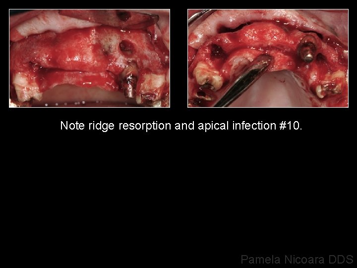 Note ridge resorption and apical infection #10. Pamela Nicoara DDS 
