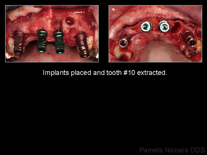 Implants placed and tooth #10 extracted. Pamela Nicoara DDS 