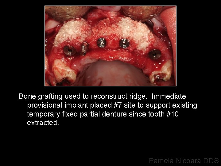 Bone grafting used to reconstruct ridge. Immediate provisional implant placed #7 site to support