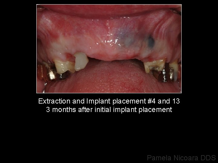 Extraction and Implant placement #4 and 13 3 months after initial implant placement Pamela
