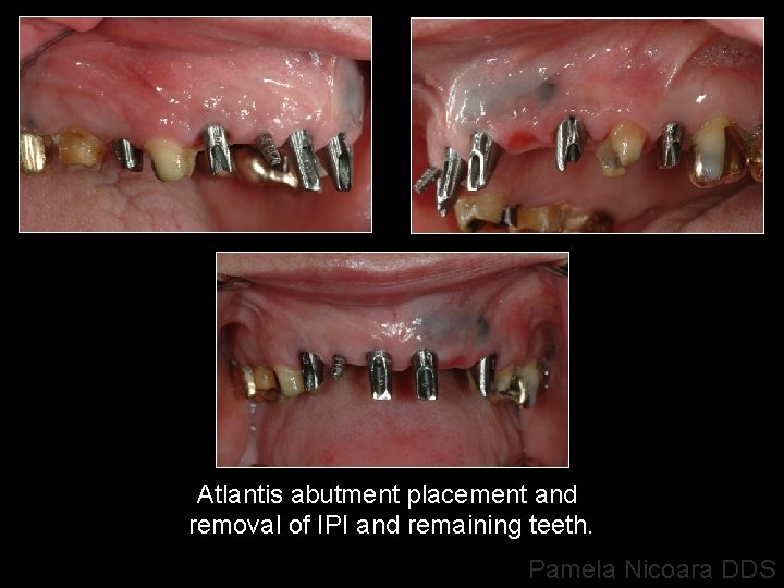 Atlantis abutment placement and removal of IPI and remaining teeth. Pamela Nicoara DDS 