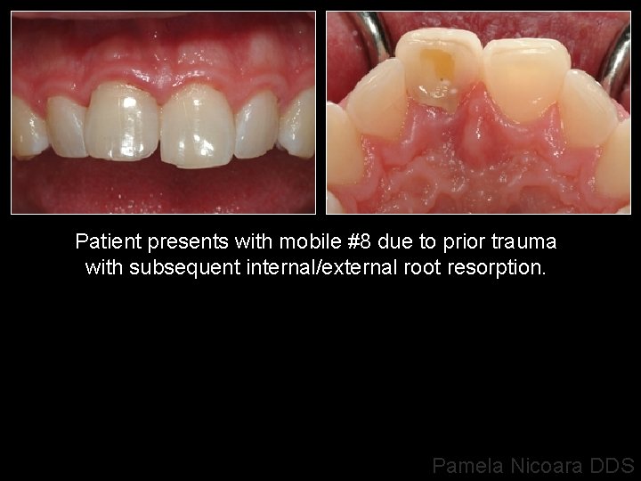 Patient presents with mobile #8 due to prior trauma with subsequent internal/external root resorption.