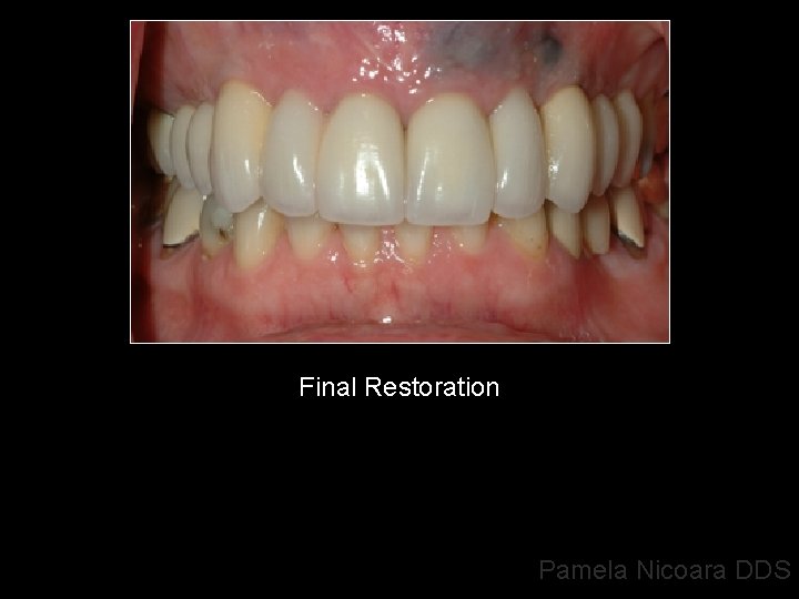 Final Restoration Pamela Nicoara DDS 