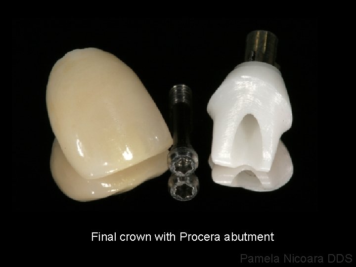 Final crown with Procera abutment Pamela Nicoara DDS 