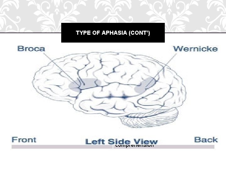 TYPE OF APHASIA (CONT’) Syndrome Type Fluent Aphasia Characteristic Wernike’s Fluent but often meaningless