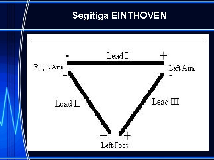 Segitiga EINTHOVEN 