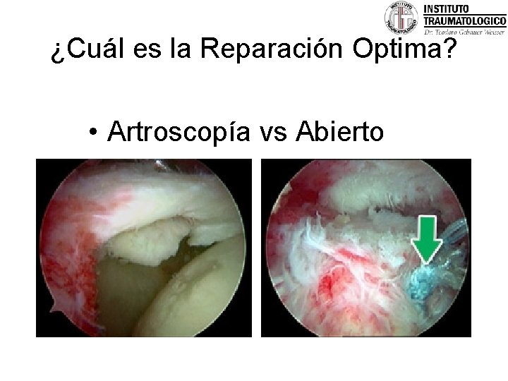 ¿Cuál es la Reparación Optima? • Artroscopía vs Abierto 
