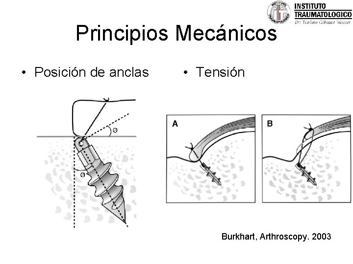 Principios Mecánicos • Posición de anclas • Tensión Burkhart, Arthroscopy. 2003 