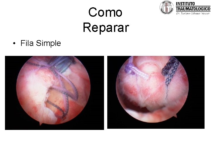 Como Reparar • Fila Simple 