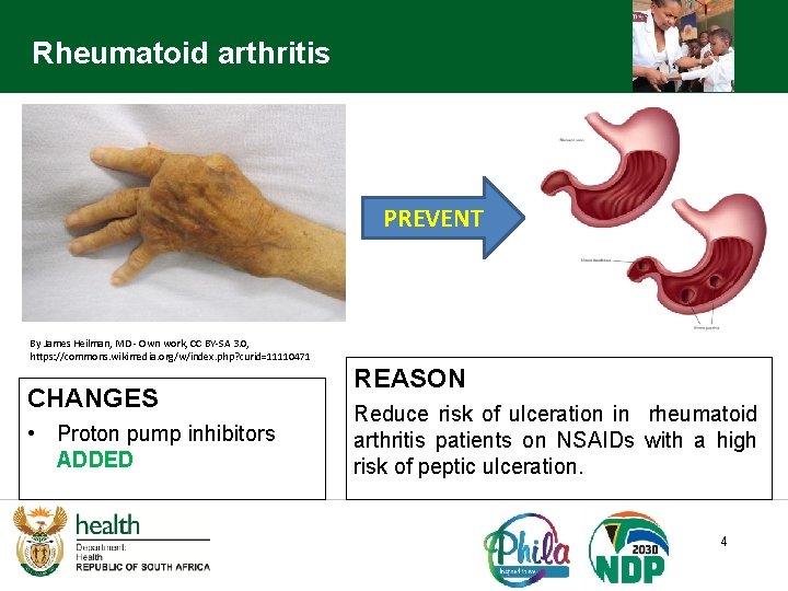 Rheumatoid arthritis PREVENT By James Heilman, MD - Own work, CC BY-SA 3. 0,
