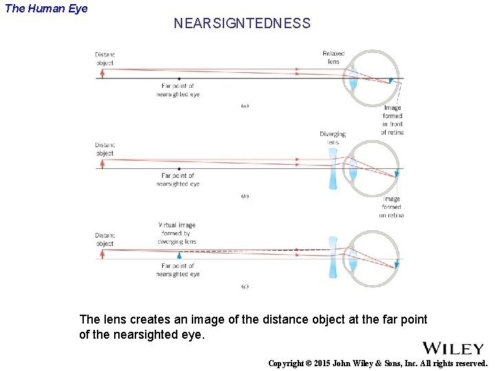 The Human Eye NEARSIGNTEDNESS The lens creates an image of the distance object at