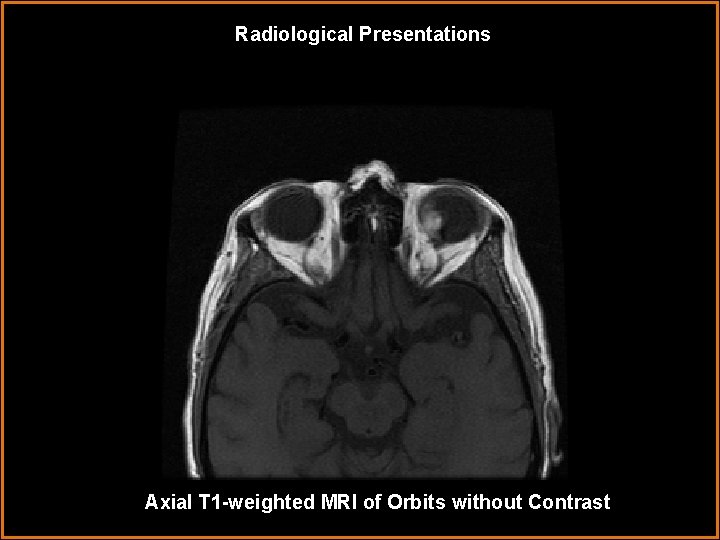 Radiological Presentations Axial T 1 -weighted MRI of Orbits without Contrast 