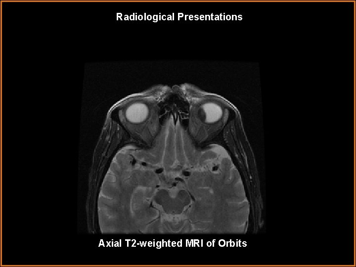 Radiological Presentations Axial T 2 -weighted MRI of Orbits 