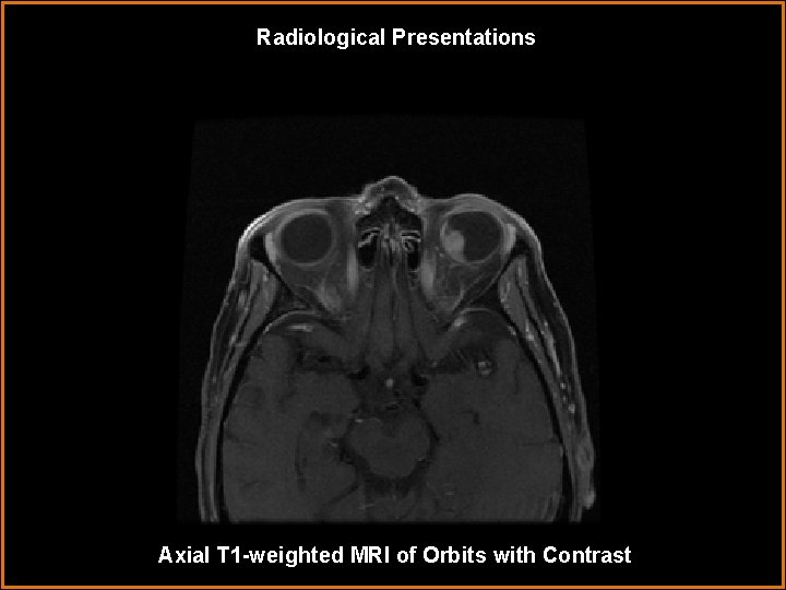 Radiological Presentations Axial T 1 -weighted MRI of Orbits with Contrast 