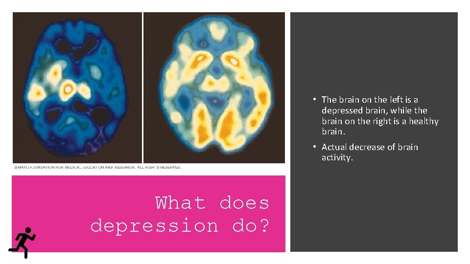  • The brain on the left is a depressed brain, while the brain