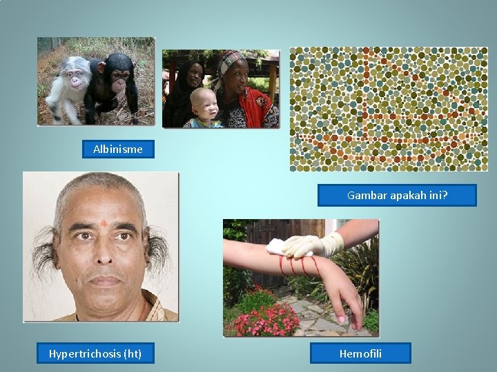 Albinisme Gambar apakah ini? Hypertrichosis (ht) Hemofili 