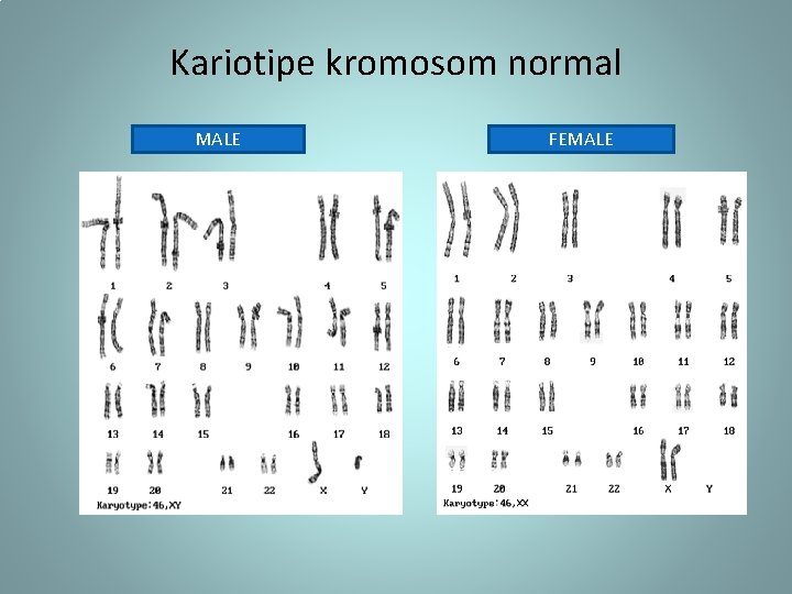 Kariotipe kromosom normal MALE FEMALE 