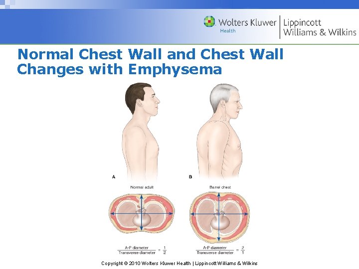 Normal Chest Wall and Chest Wall Changes with Emphysema Copyright © 2010 Wolters Kluwer