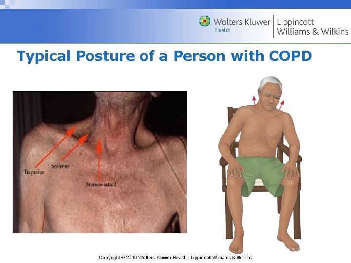 Typical Posture of a Person with COPD Copyright © 2010 Wolters Kluwer Health |