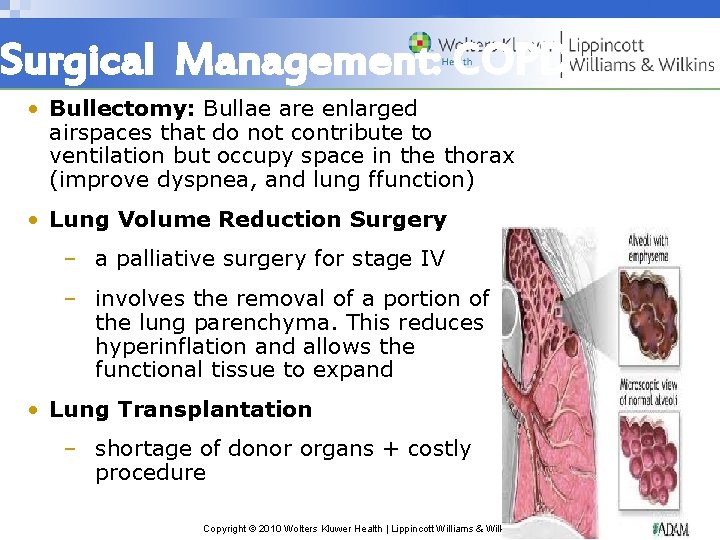 Surgical Management: COPD • Bullectomy: Bullae are enlarged airspaces that do not contribute to