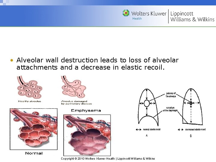  • Alveolar wall destruction leads to loss of alveolar attachments and a decrease