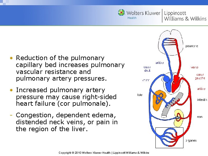  • Reduction of the pulmonary capillary bed increases pulmonary vascular resistance and pulmonary