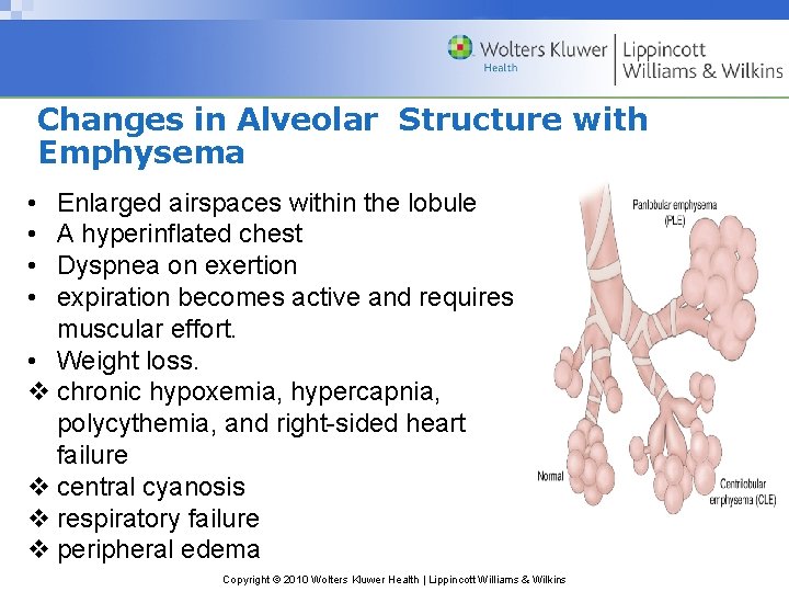Changes in Alveolar Structure with Emphysema • • Enlarged airspaces within the lobule A