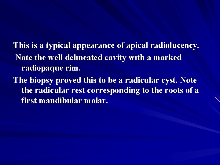 This is a typical appearance of apical radiolucency. Note the well delineated cavity with