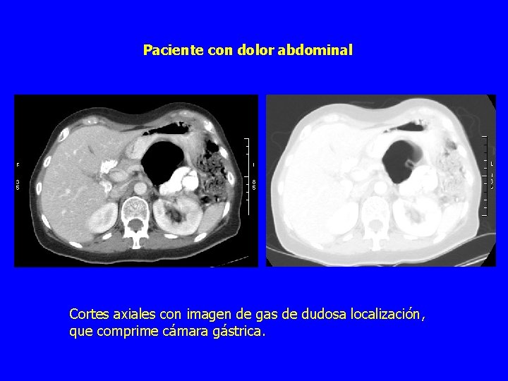 Paciente con dolor abdominal Cortes axiales con imagen de gas de dudosa localización, que