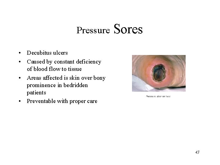 Pressure Sores • Decubitus ulcers • Caused by constant deficiency of blood flow to