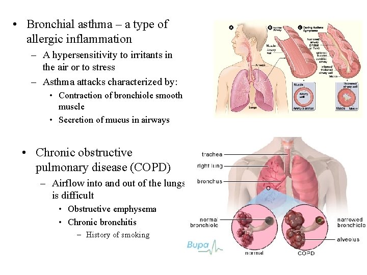  • Bronchial asthma – a type of allergic inflammation – A hypersensitivity to