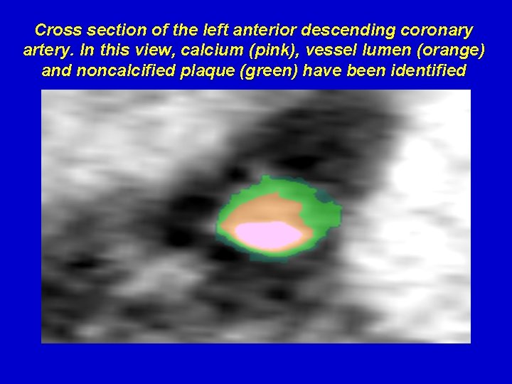 Cross section of the left anterior descending coronary artery. In this view, calcium (pink),