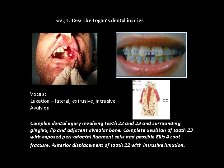 SAQ 1. Describe Logan’s dental injuries. Vocab: Luxation – lateral, extrusive, intrusive Avulsion Complex