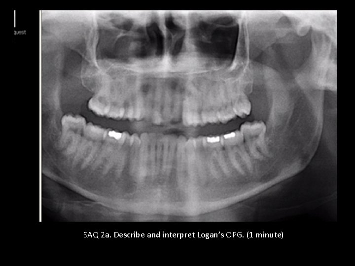 SAQ 2 a. Describe and interpret Logan’s OPG. (1 minute) 