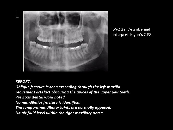 SAQ 2 a. Describe and interpret Logan’s OPG. REPORT: Oblique fracture is seen extending
