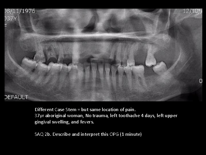 Different Case Stem = but same location of pain. 37 yr aboriginal woman, No