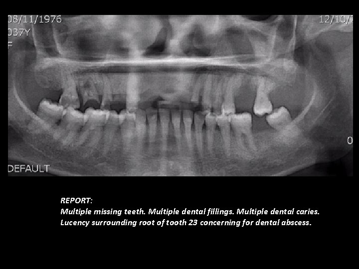 REPORT: Multiple missing teeth. Multiple dental fillings. Multiple dental caries. Lucency surrounding root of