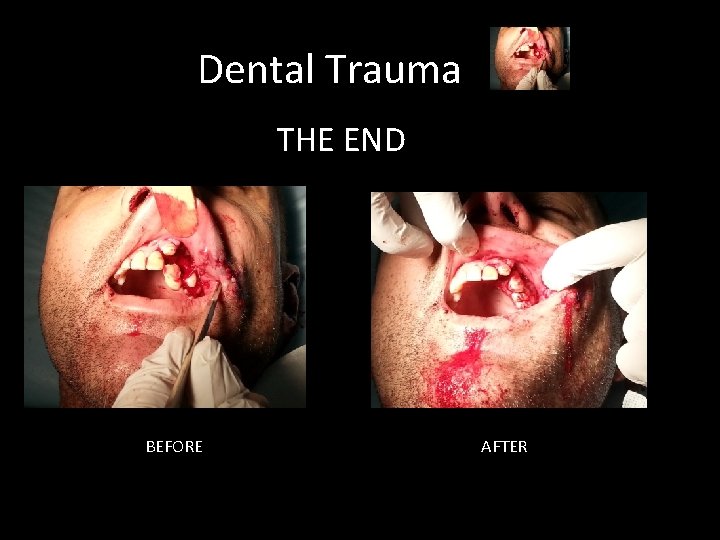 Dental Trauma THE END BEFORE AFTER 