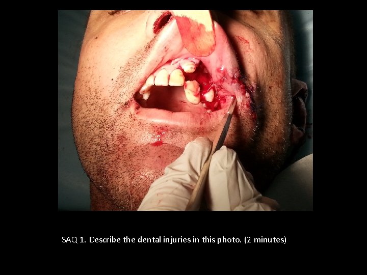 SAQ 1. Describe the dental injuries in this photo. (2 minutes) 