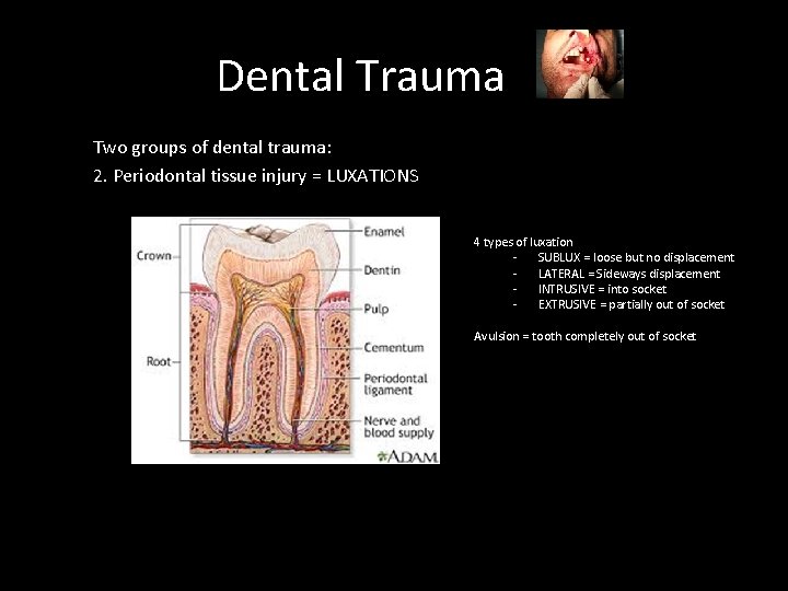 Dental Trauma Two groups of dental trauma: 2. Periodontal tissue injury = LUXATIONS 4
