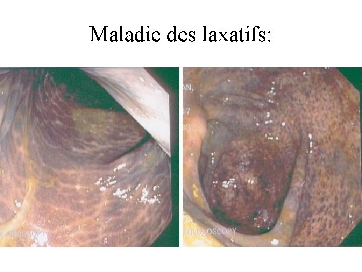 Maladie des laxatifs: 